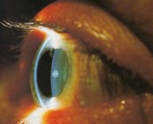 Retinasejt átültetéssel javítható a látás?