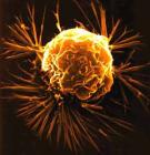 A ráksejtek öregedését és halálát idézi elõ egy új típusú kezelés