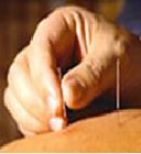 Akupunktúrával a rákos fájdalmak ellen