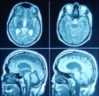 Évtizedekkel a betegség elõtt kimutathatók neurodegeneratív elváltozások Alzheimer-kórban