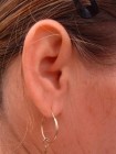 Kevesen hallanak a hallásjavító mûtétrõl - Mi a cochleáris implantáció?