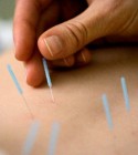 Nem a technika, hanem a tû lehet az akupunktúra titka