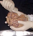 Az agymûködés megértése vezethet el az idegrendszeri betegségek gyógyításához