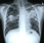 A tuberkulózis világnapja 
