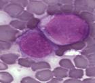 Leukémiás sejtek támadható pontjait azonosították