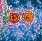 A herpesz kezelésével idõt nyerhetnek a HIV-fertõzötteknél