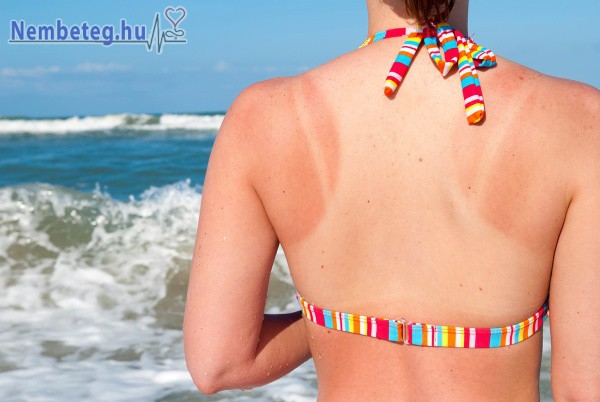 A napégés fokozza a bőrbetegségek kialakulását