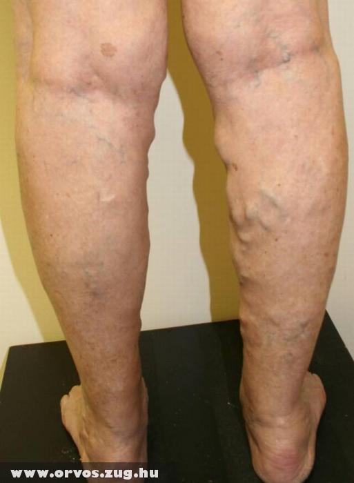 a lábak varikózisának utolsó szakasza fényképpel visszér kezelés vásárolni