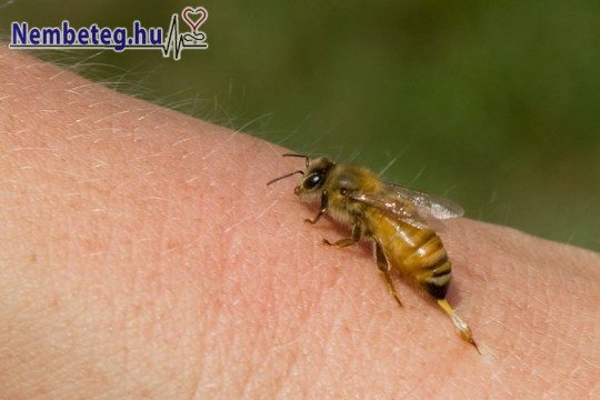 Méhcsípés