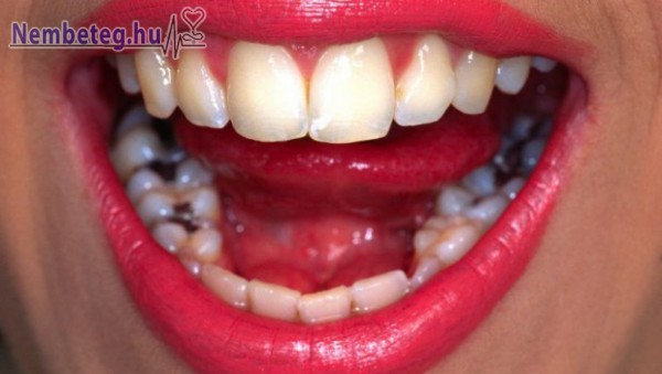 Rossz - lyukas fogak