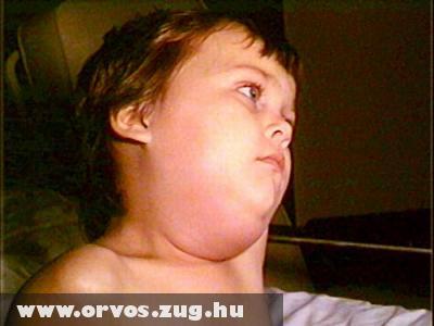 Mumpszos gyerek
