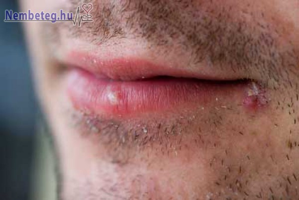 száj körüli herpesz vírus