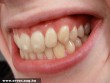A vitaminhiány a fogakon is megjelenik