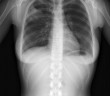 Gerinc röntgen