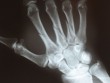 Törött kéz röntgenje