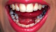 Rossz - lyukas fogak