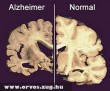Az agy elváltozása az Alzheimer-kór következtében